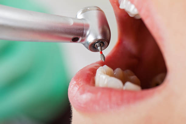 Best Emergency Dentist for Lost Fillings or Crowns in Westvle, IL